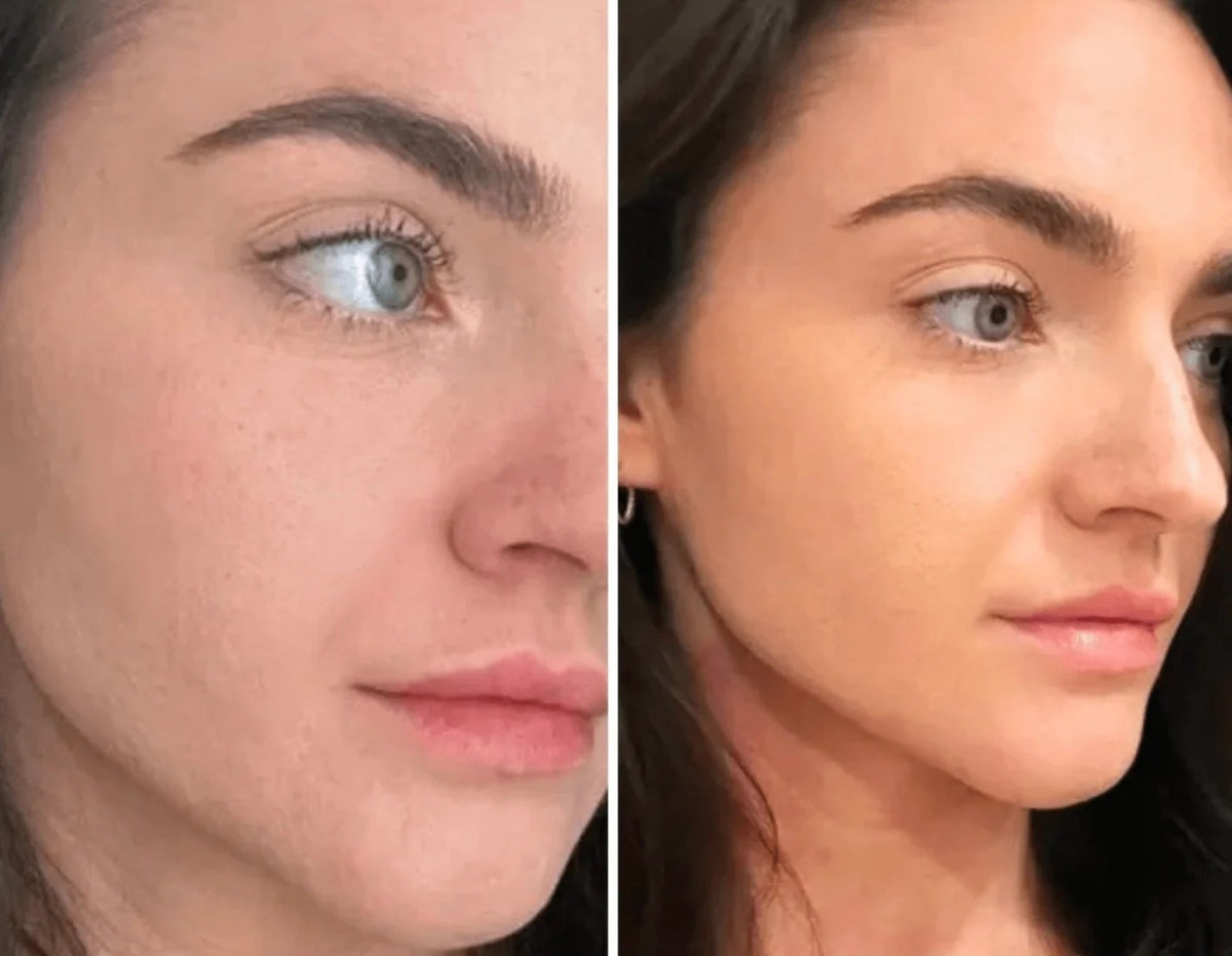 Aimie 32 ans | Masque LED