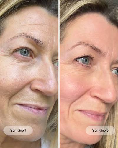 Sophie 57 ans | Masque LED